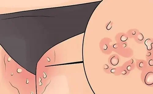 sentetik iç çamaşırlarının cilt ve genital sağlık üzerinde olumsuz etkileri, illustrasyon